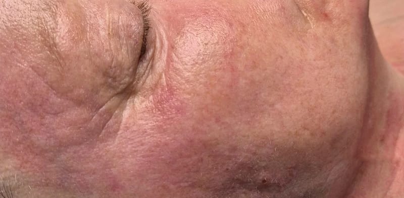 Hautbild direkt nach dem Microneedling im NaKo Institut Strausberg