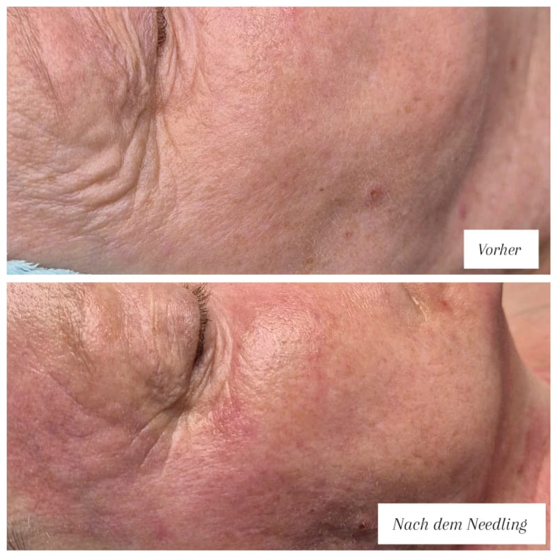 Echtes Vorher-Nachher-Ergebnis aus dem NaKo Institut: Hautbild vor und nach dem Microneedling