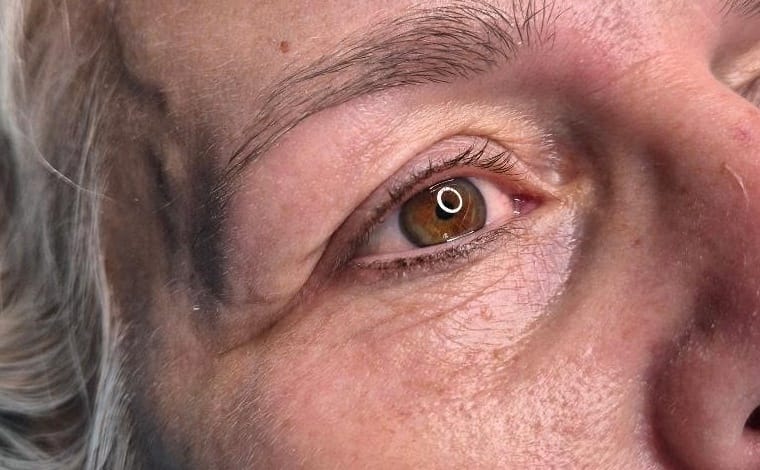 Augenpartie nach einer Plasma-Lidstraffung im NaKo Institut Strausberg